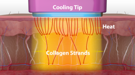 FLX uses radiofrequency technology to heat the deep, collagen-rich layers of the skin, while the tip vibrates and cools the surface to help aid in patient comfort.
