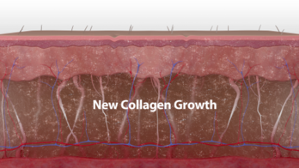 Over the next few months, the secondary healing response continues as collagen is deposited and remodeled.