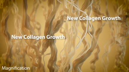 The new collagen growth tightens the skin further over time.