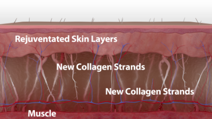 For smoother, tighter skin after just one treatment, with continued improvement for up to six months.
