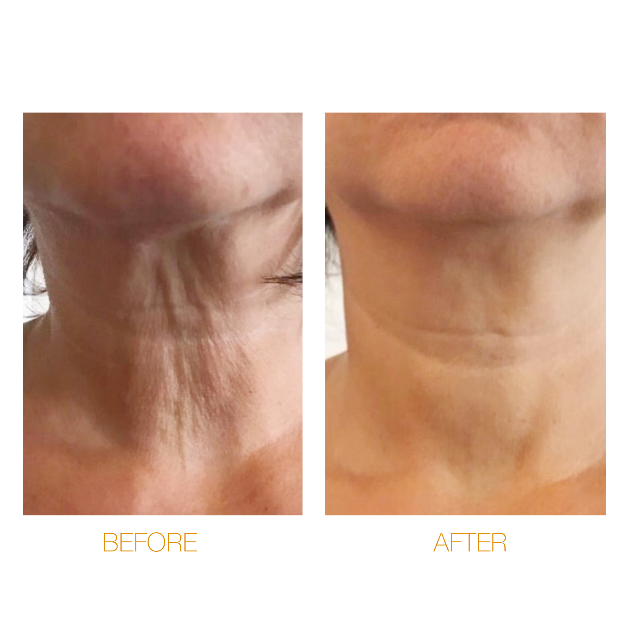 Target : Neck Flaccidity