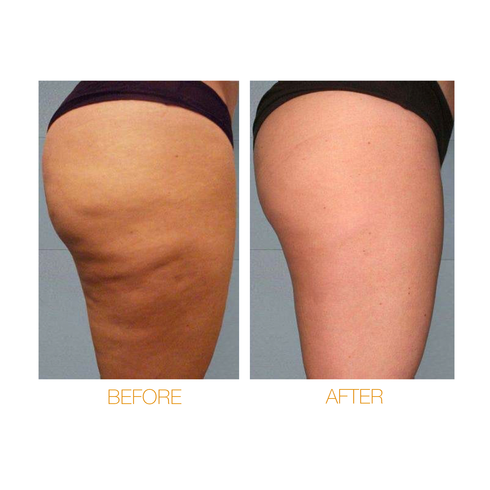 Target : Cellulite