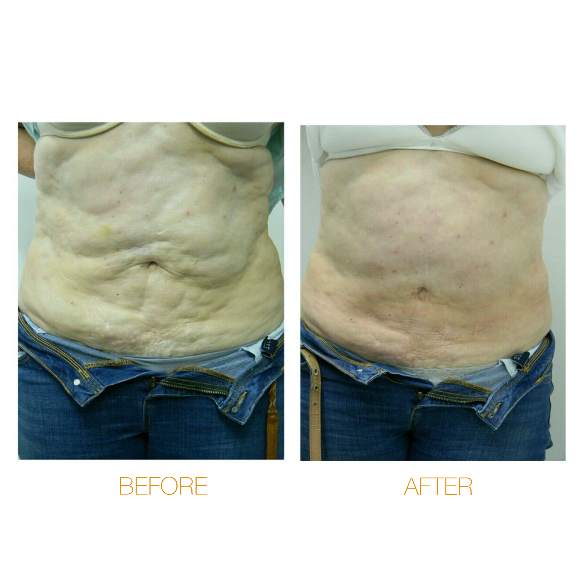 Target : Post-liposuction fibrosis