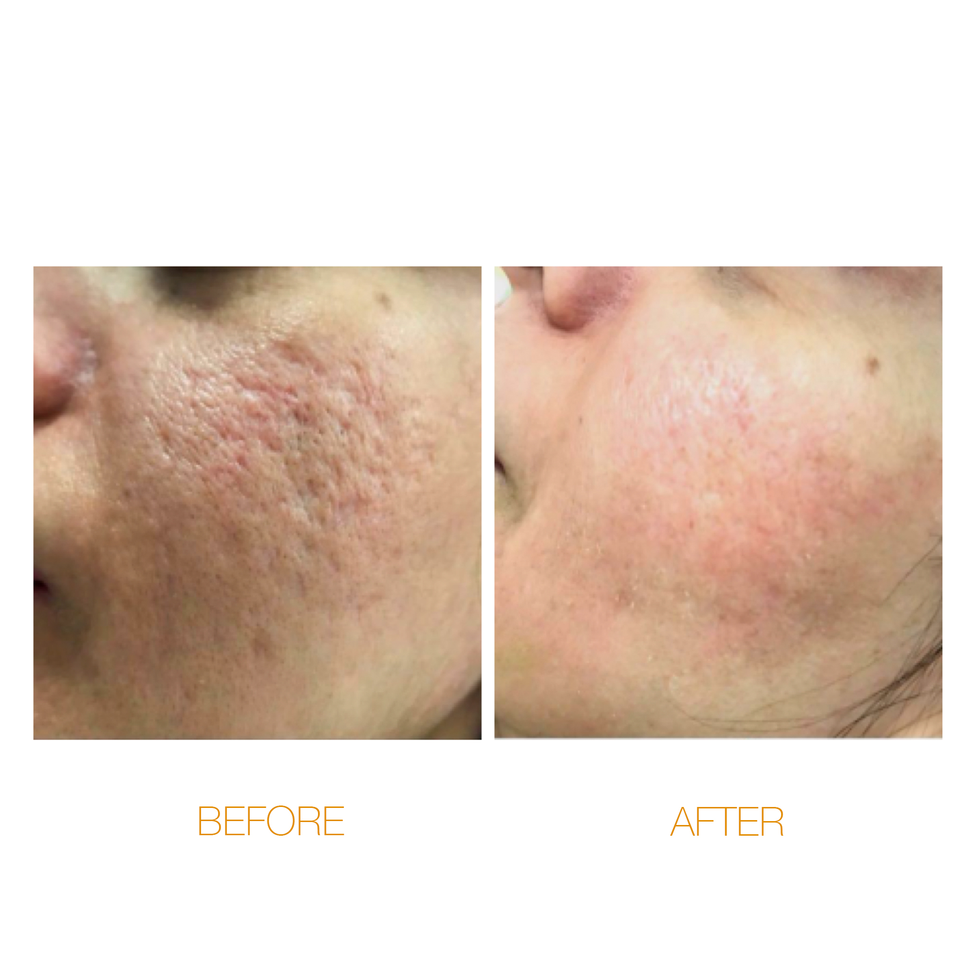 Target : Post Acne scars